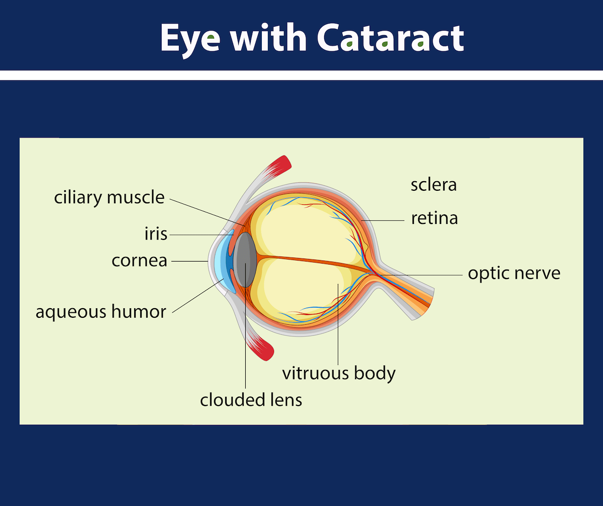 cataract-surgery-ophthalmology-associates-of-staten-island